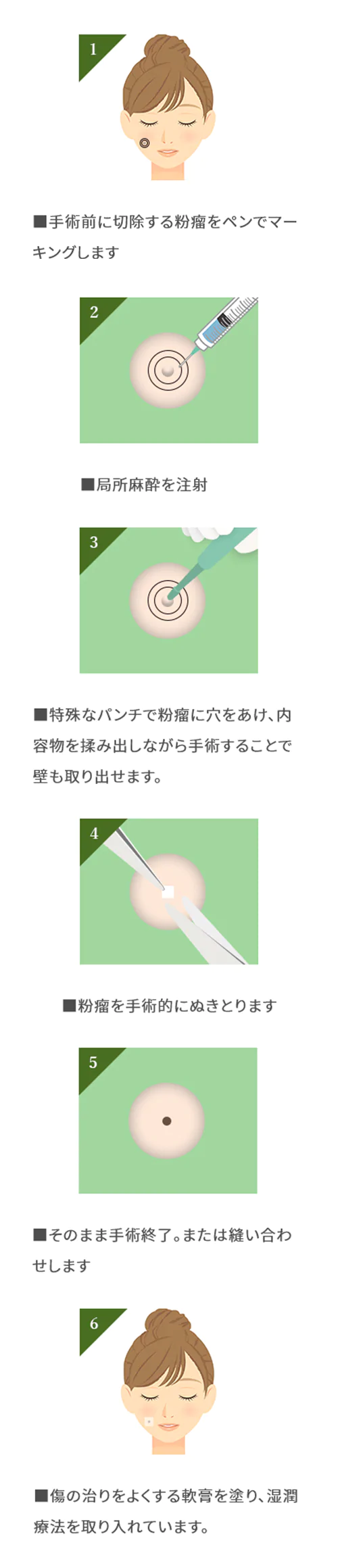 手術前に切除する粉瘤をペンでマーキングします 局所麻酔を注射 特殊なパンチで粉瘤に穴をあけ、内容物を揉み出しながら手術することで壁も取り出せます。 粉瘤を手術的にぬきとります そのまま手術終了。または縫い合わせします 傷の治りをよくする軟膏を塗り、湿潤療法を取り入れています。